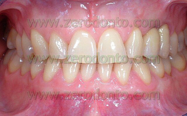 dental malocclusion