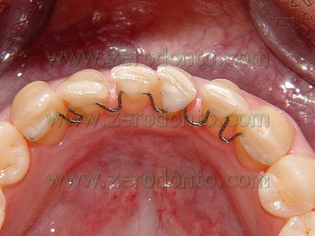 dental malocclusion treatment