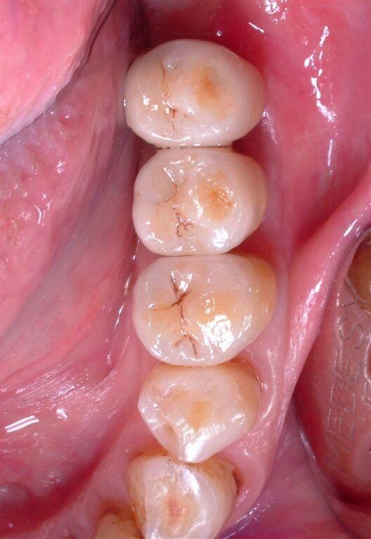 Implant-reatined premolars