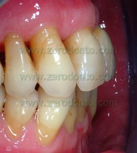 gingival retraction