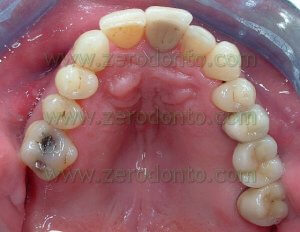orthodontic therapy in patient with dental implant