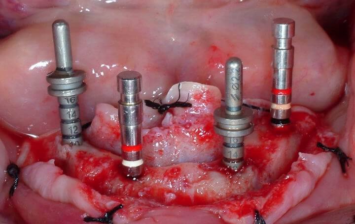 Interforaminal implants
