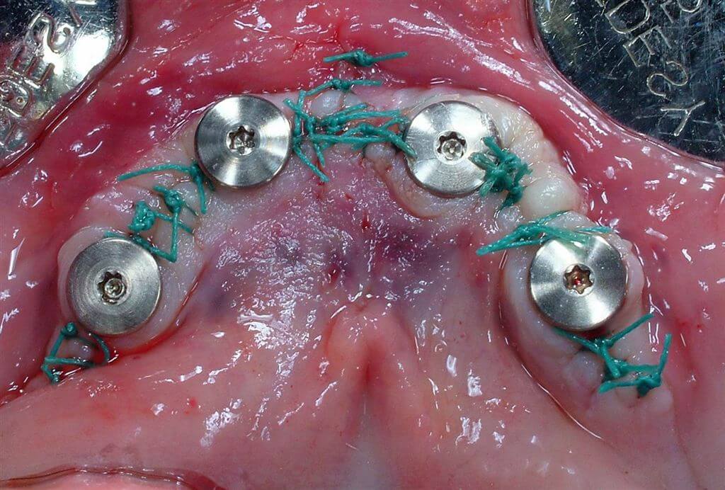 Implant cover screws