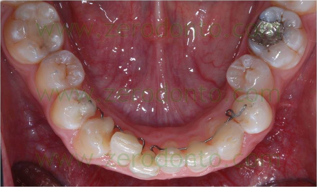 lingual orthodontic