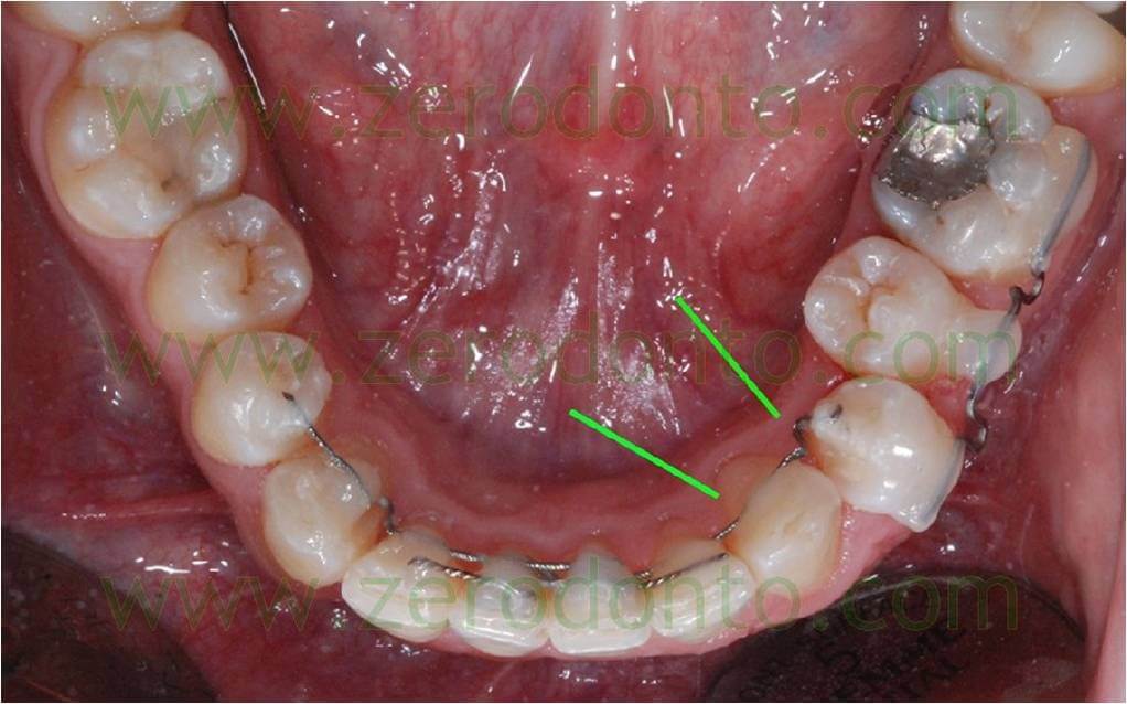 invisible orthodontic without brackets