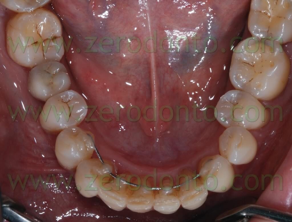 Invisible Orthodontics: lingual Orthodontics without brackets, Zerodonto