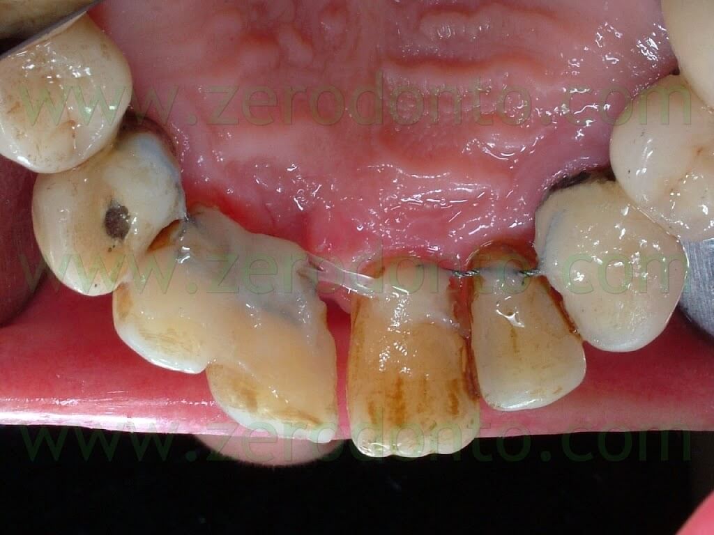 orthodontic retainer