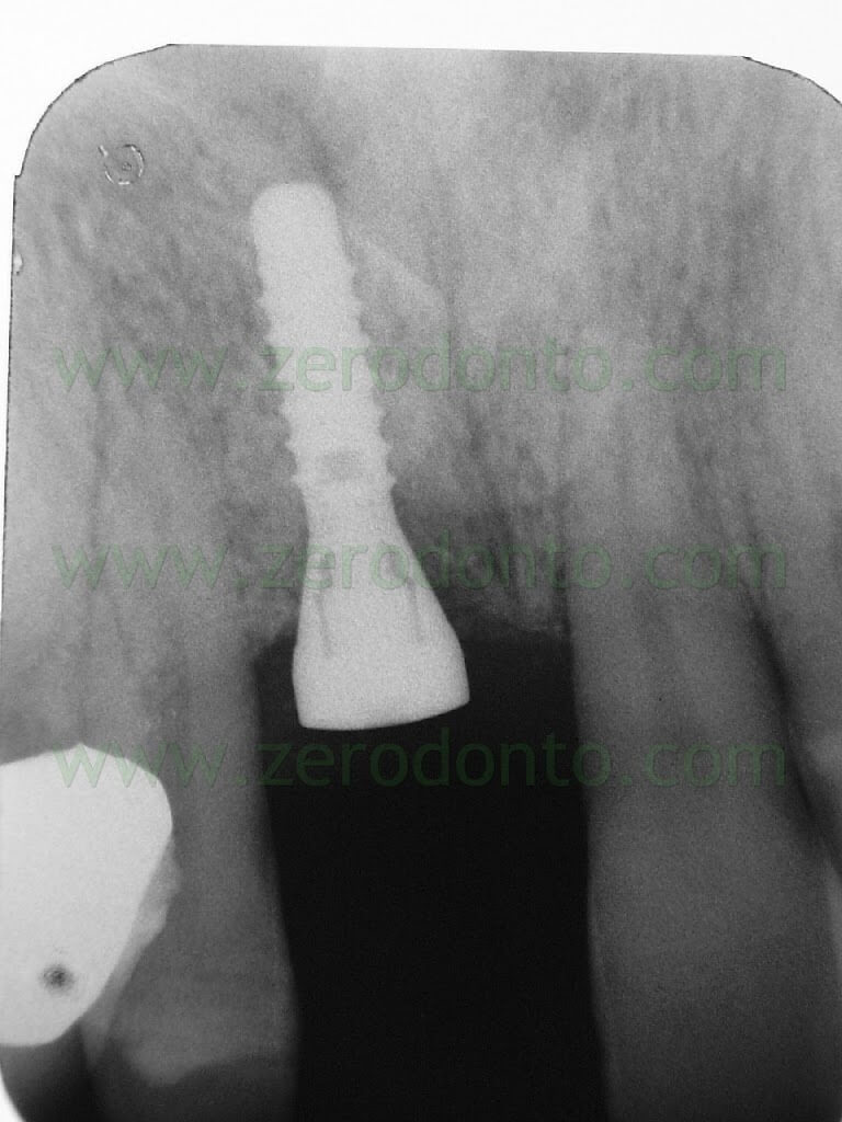 straumann implant x ray
