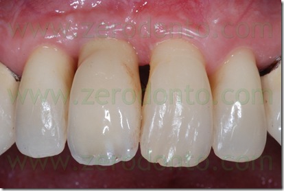 esthetic area implant