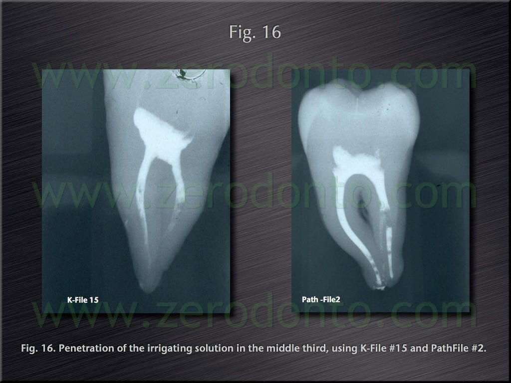endodontics vertical obturation