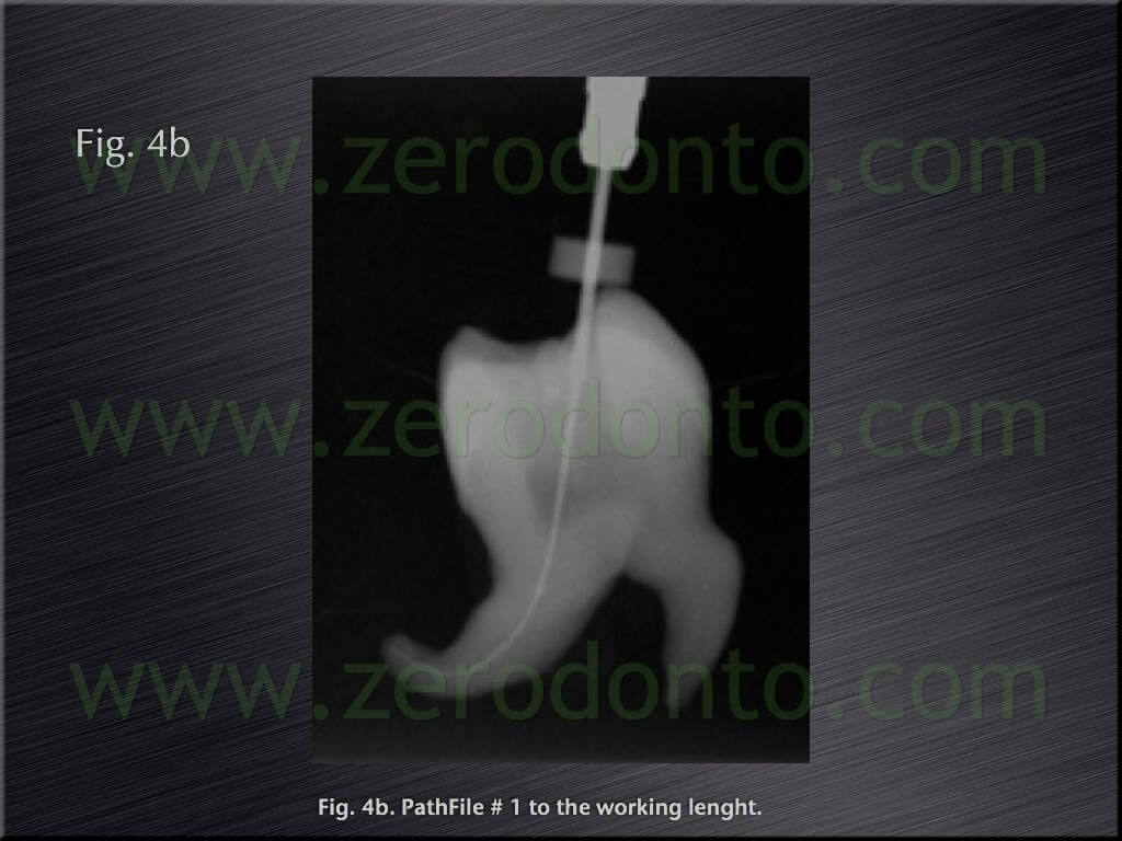 preflaring root canal