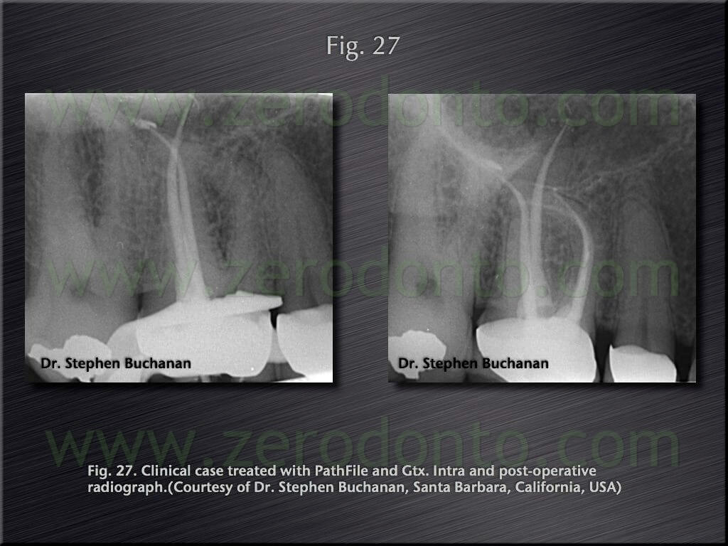 root canal castellucci