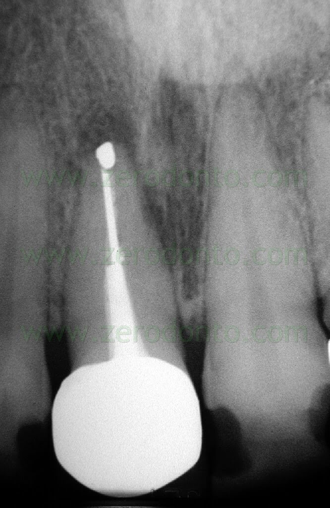 Apicoectomy surgical endodontics