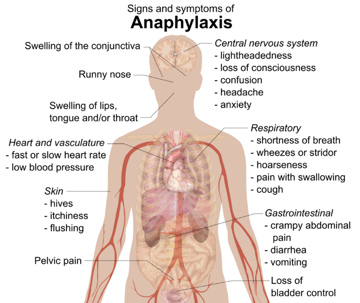 Anaphylaxis | Dr. Caterina Detoraki | Zerodonto