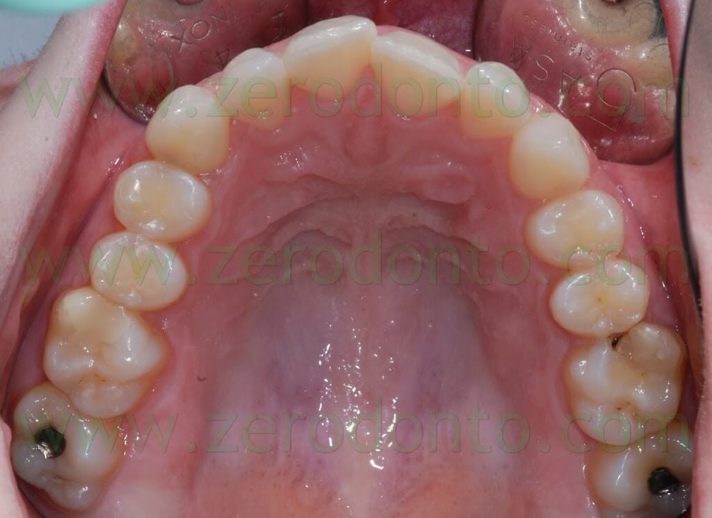 pre-treatment upper occlusal view