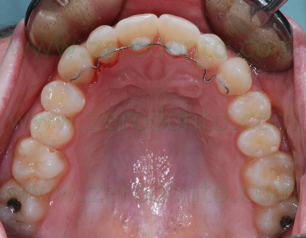 post invisible therapy upper occlusal view