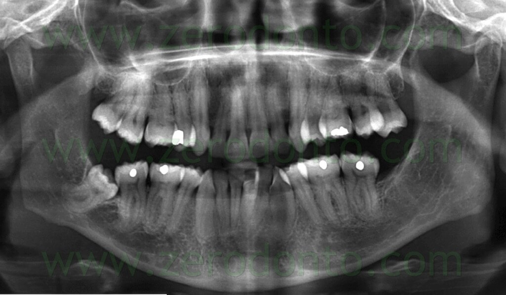 2 orthopantomogram impacted mandibular third molar