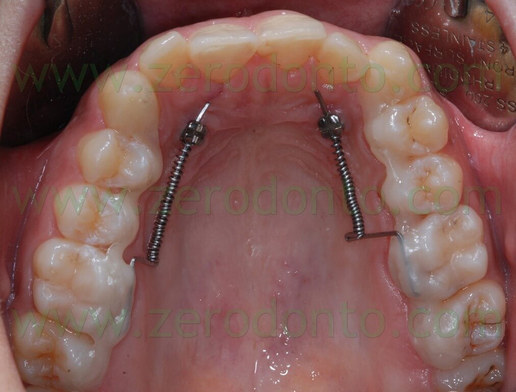 palatal mini-screws and coils