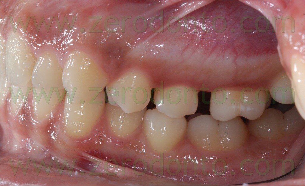 molars distalization