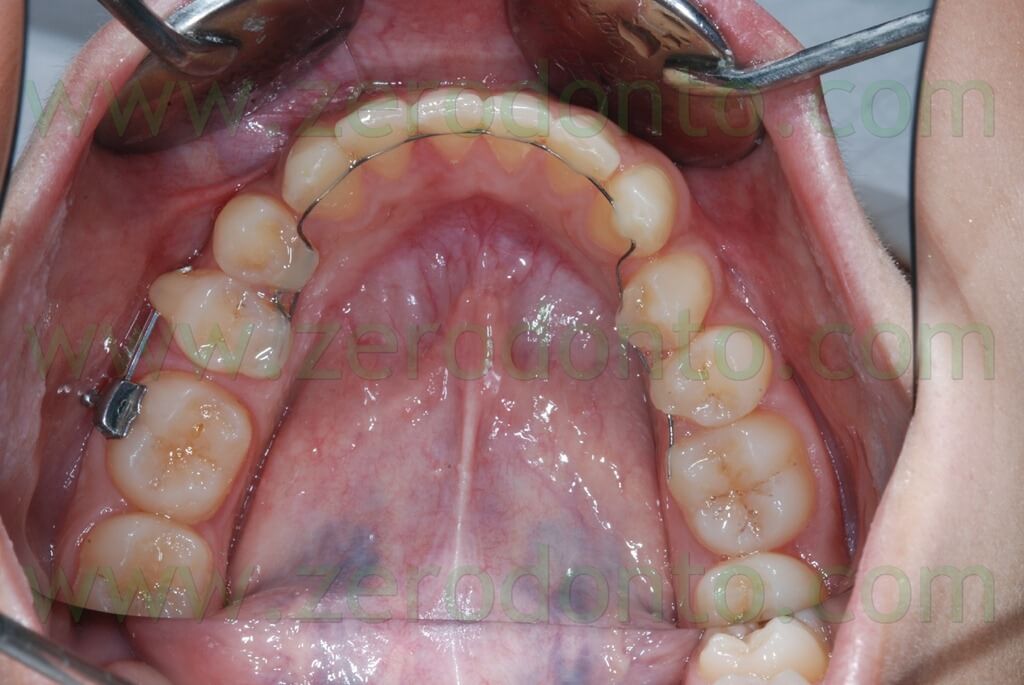 molar uprighting 