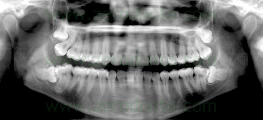 6 x-ray mandibular third molar