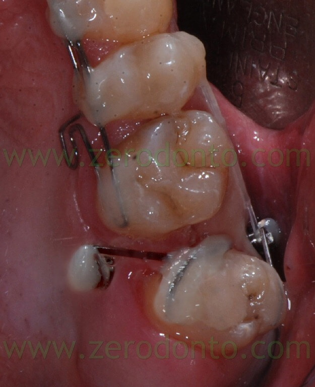 19 minivite ortodonzia