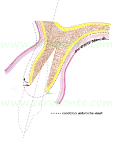 espansione ossea controllata split crest zona estetica