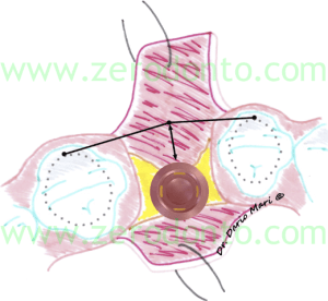 linee guida ITI sac impianto in zona estetica 1-2mm zona comfort implant placement consensus conference