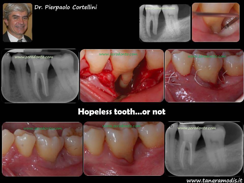“Hopeless tooth” treatment 1