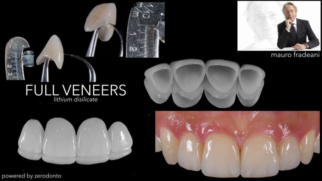 full_veneers_1