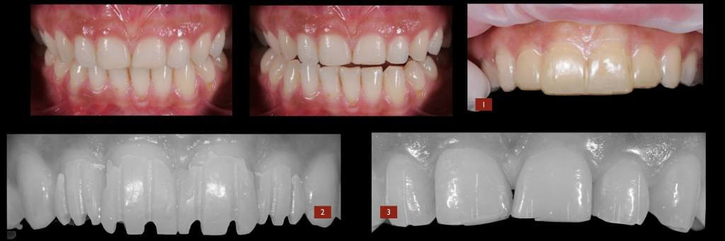 full_veneers_2