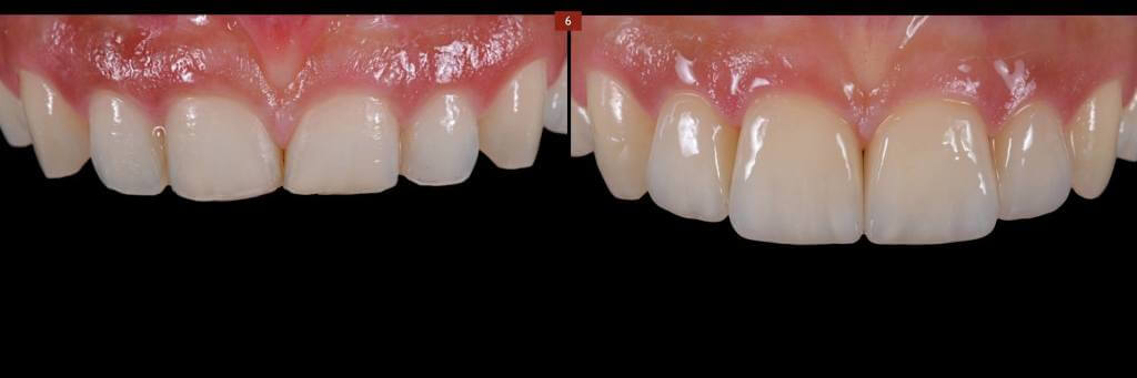 full_veneers_6