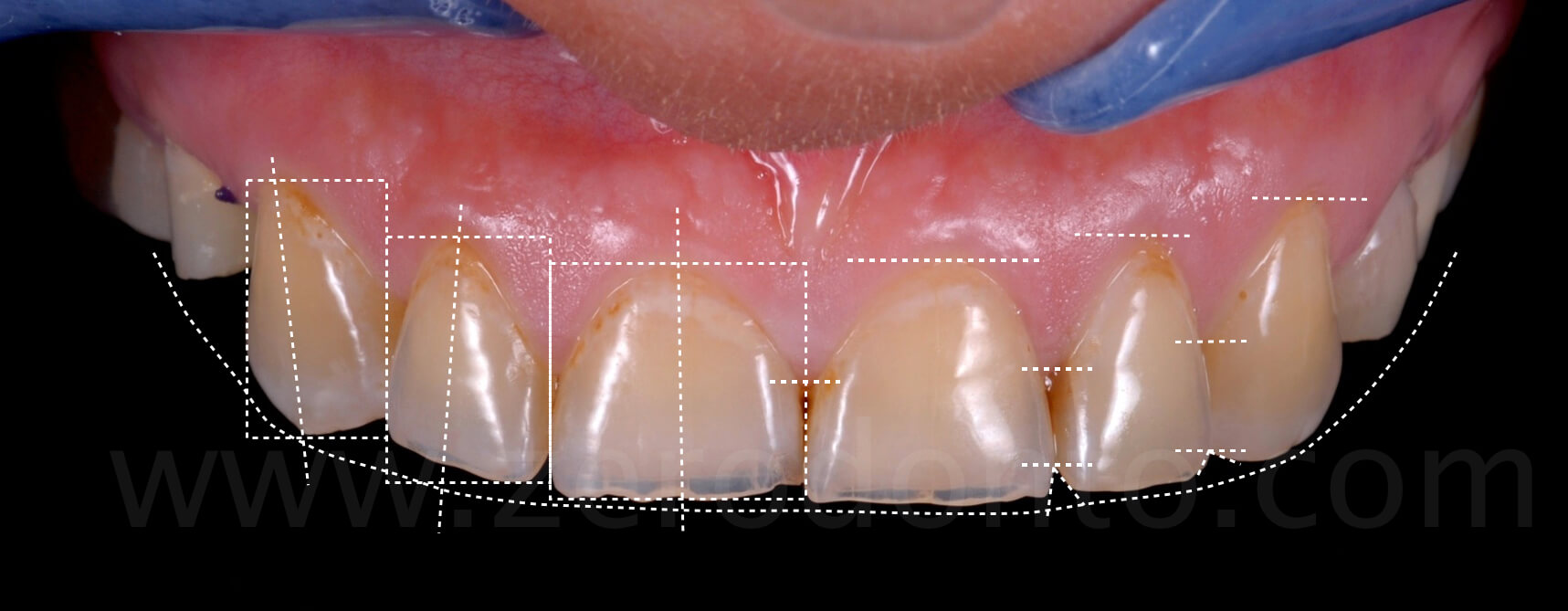 dental analysis evaluation dental erosion zerodonto fadein