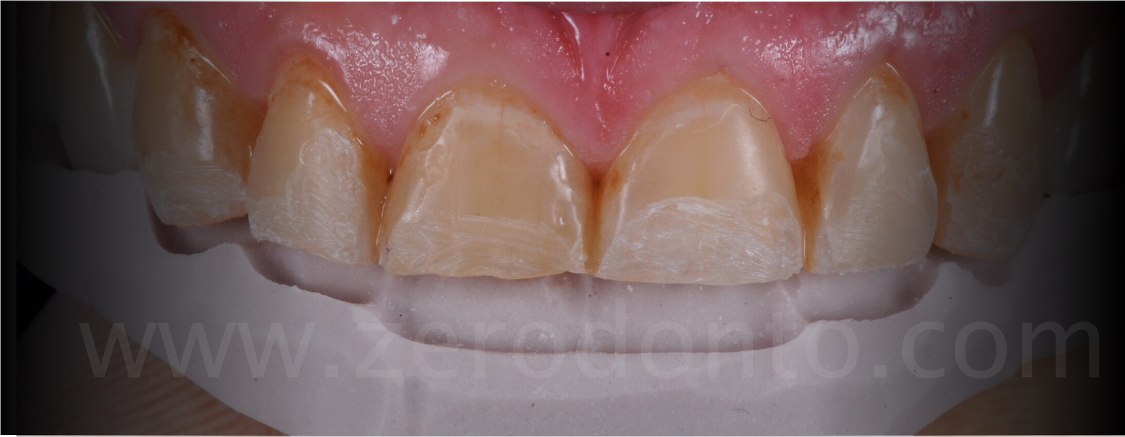 mock-up dental erosion