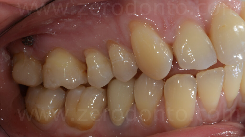 molar intrusion