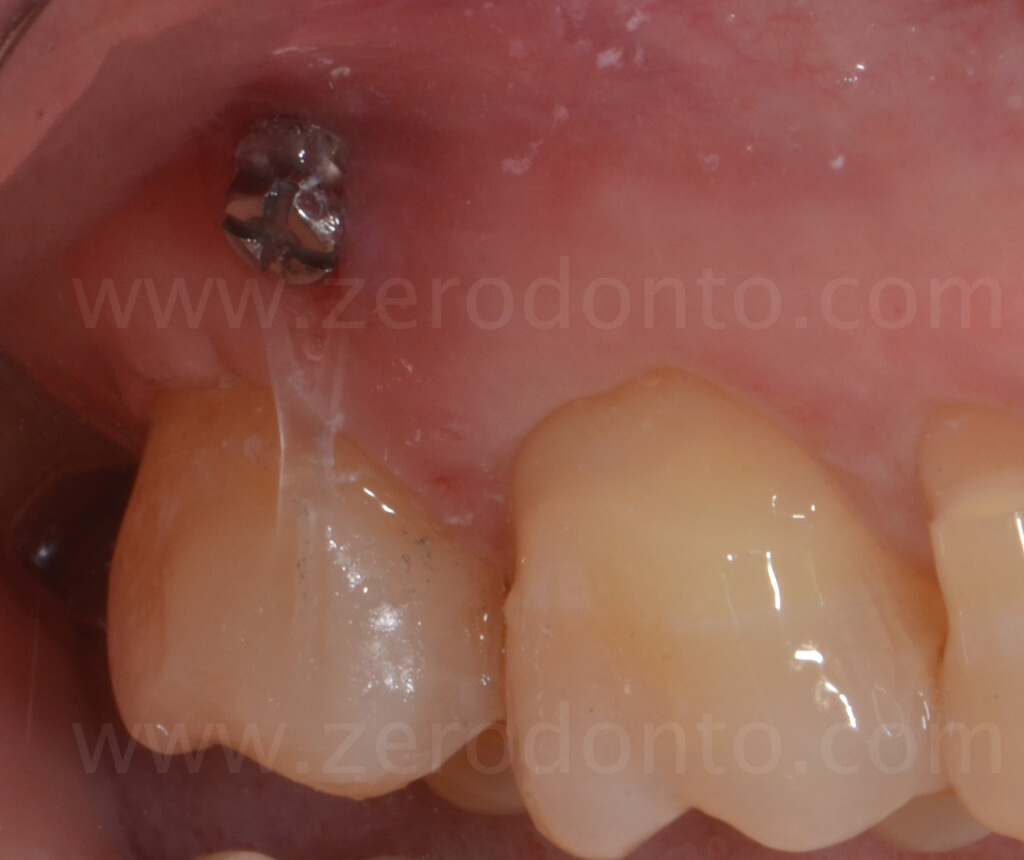 orthodontic microscrew