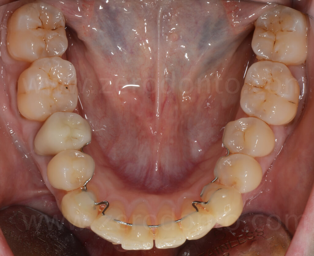 14 ortodonzia linguale