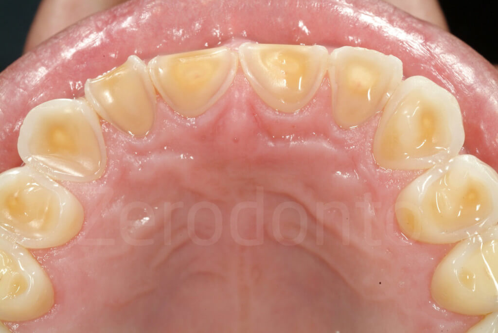 fracture of the incisal edges