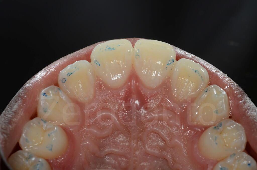 palatal aspect intact teeth