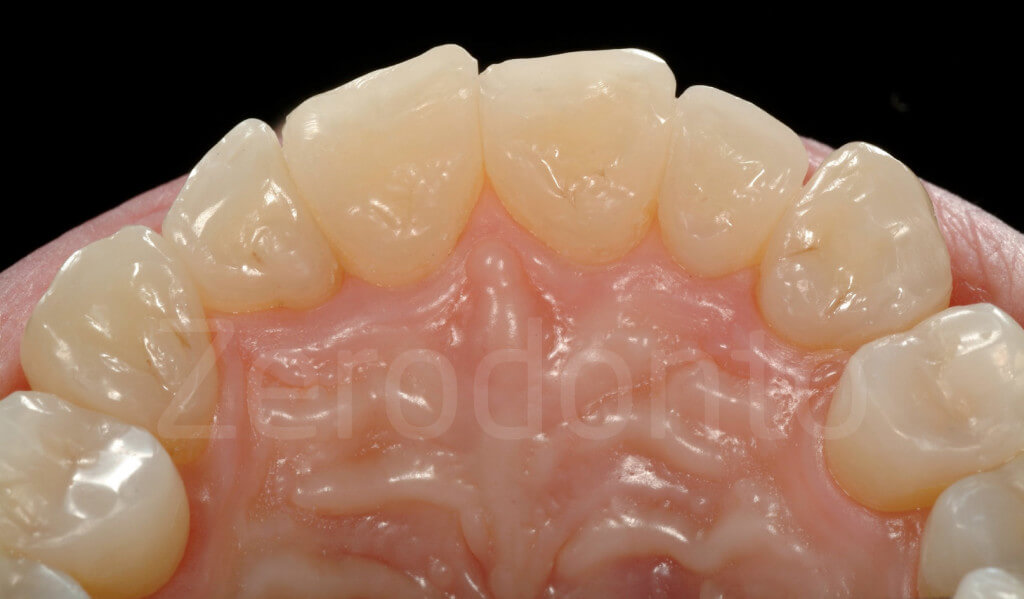 composite palatal veneers