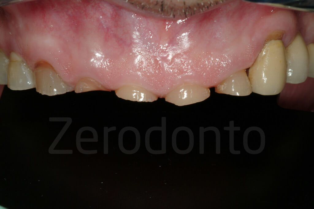 incisal edges breaking down