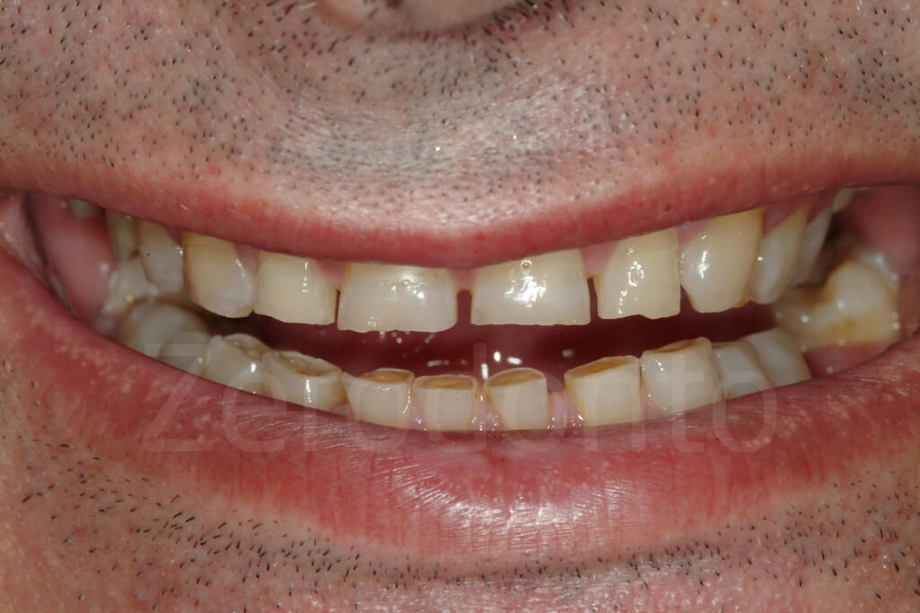 incisal edges are damaged 