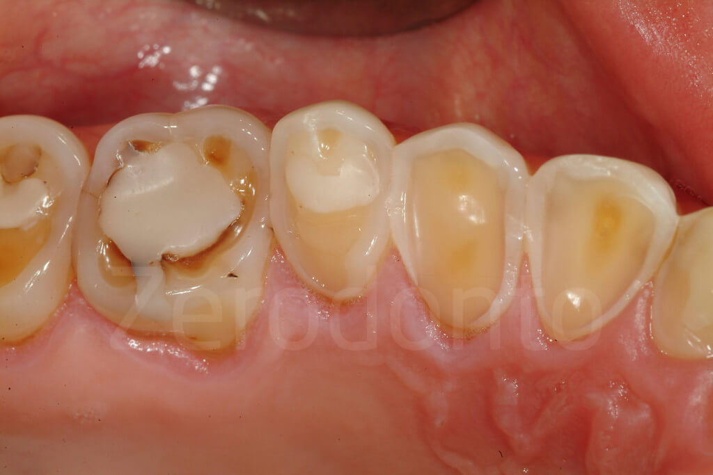 eroded dentition 