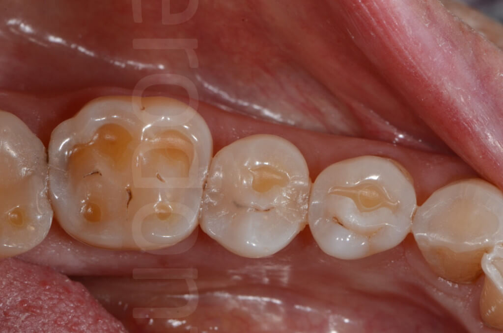 tooth degradation