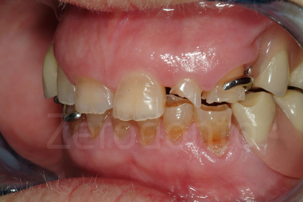 damaged teeth