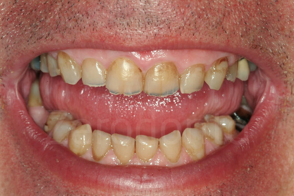 compromised incisal edge