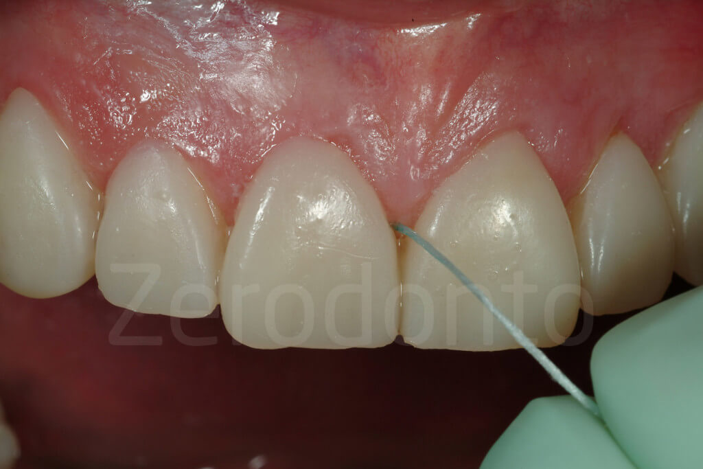 interproximal embrasures