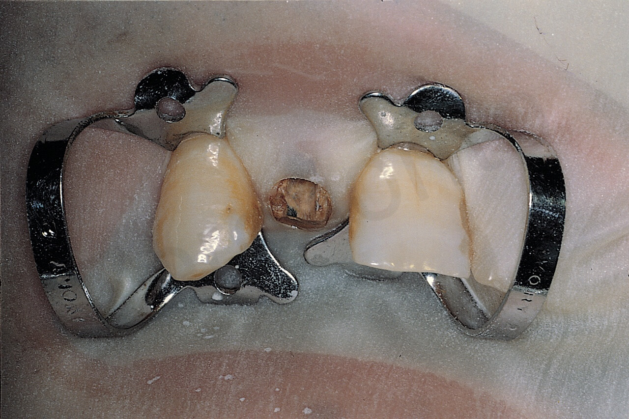The dam has been placed on the canine and central incisor to allow endodontic therapy of the root of the lateral incisor