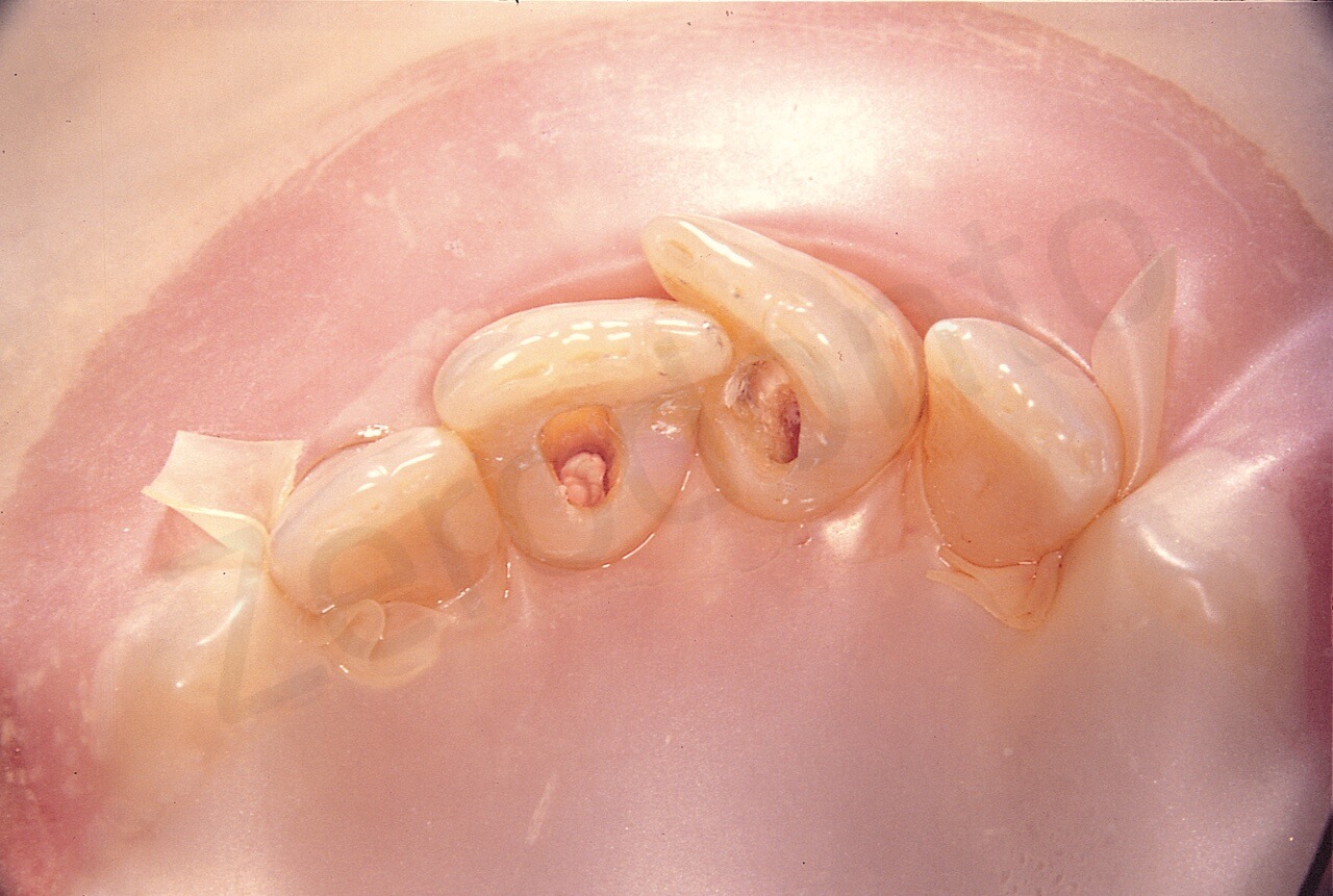 Since the front teeth of this patient were so crowded, there was no space for the clamps. The dam is kept in place by two fragments of the dam which have been passed under the distal contact areas of the lateral incisors