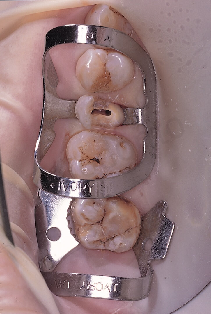 The upper right second premolar has a 45° crown fracture and the 90N clamp keeps sliding under the tension of the rubber sheet. One clamp has been positioned on the second molar and another one (90N) on the second premolar to be treated. Now the elasticity of the dam is pulling on the molar and not at all on the premolar